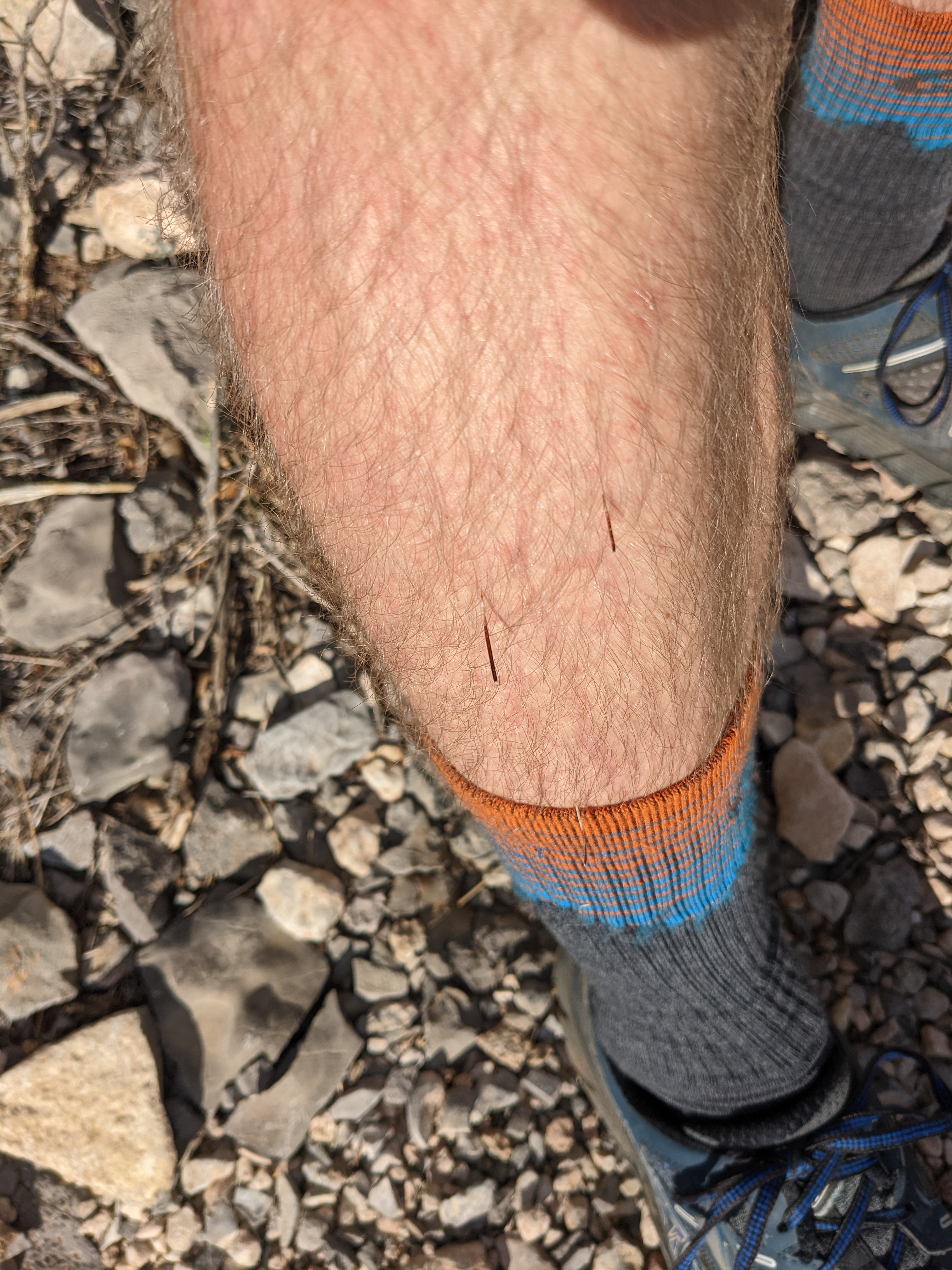 Thorns from cactus in Kyle's leg